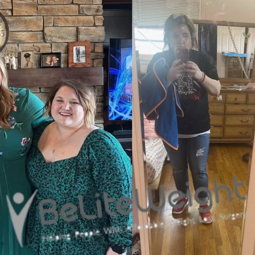 Weight Loss Surgery Gastric Sleeve before and after